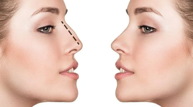 Septoplastika əməliyyatı icbari tibbi sığorta paketində