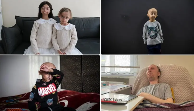 Dünyada 400 milyona yaxın insan nadir xəstəliklərlə mübarizə aparır