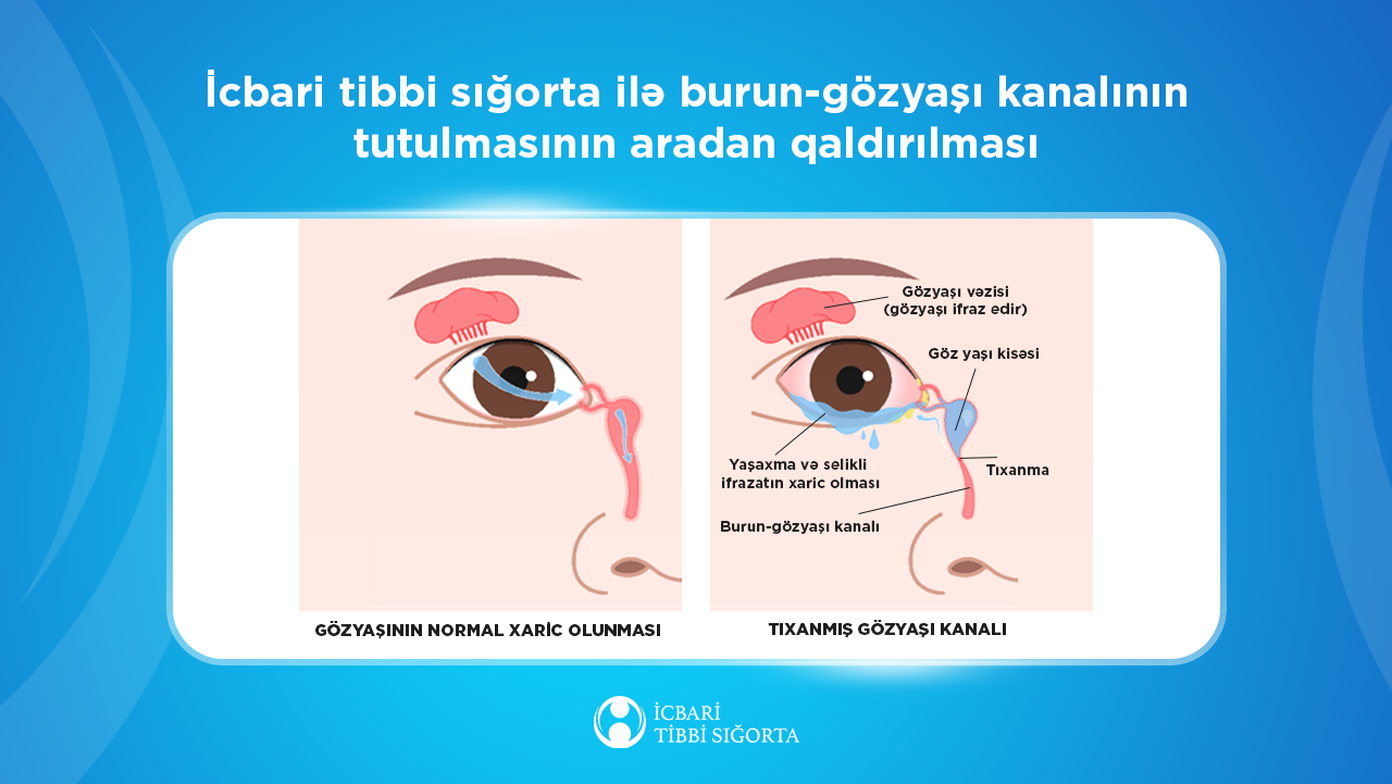 Gözyaşı axarının bərpası məqsədi ilə 234 oftalmoloji əməliyyat icra olunub