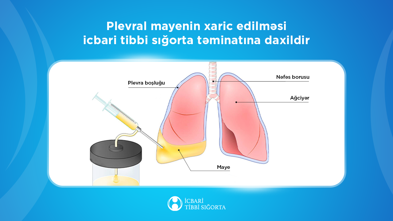 Ağciyərlərə yığılmış mayenin çəkilməsi məqsədilə 5643 prosedur icra olunub