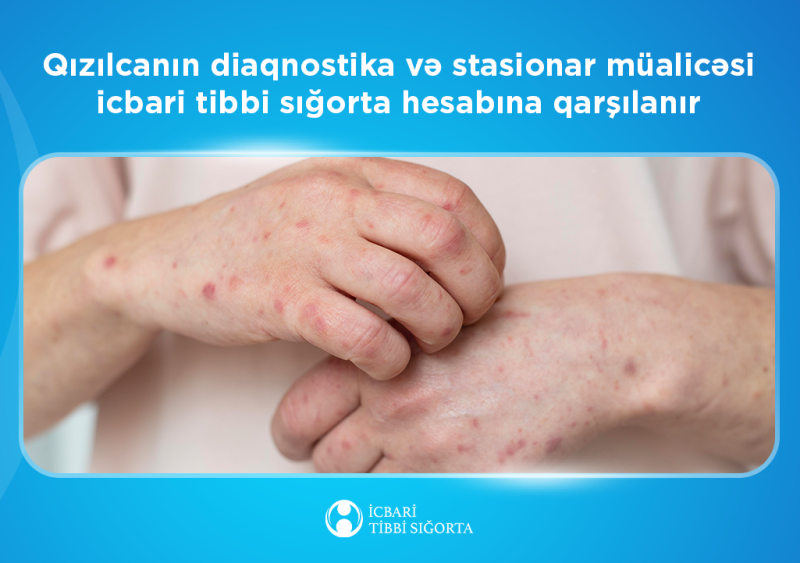 Qızılcanın diaqnostika və stasionar müalicəsi icbari tibbi sığorta hesabına qarşılanır