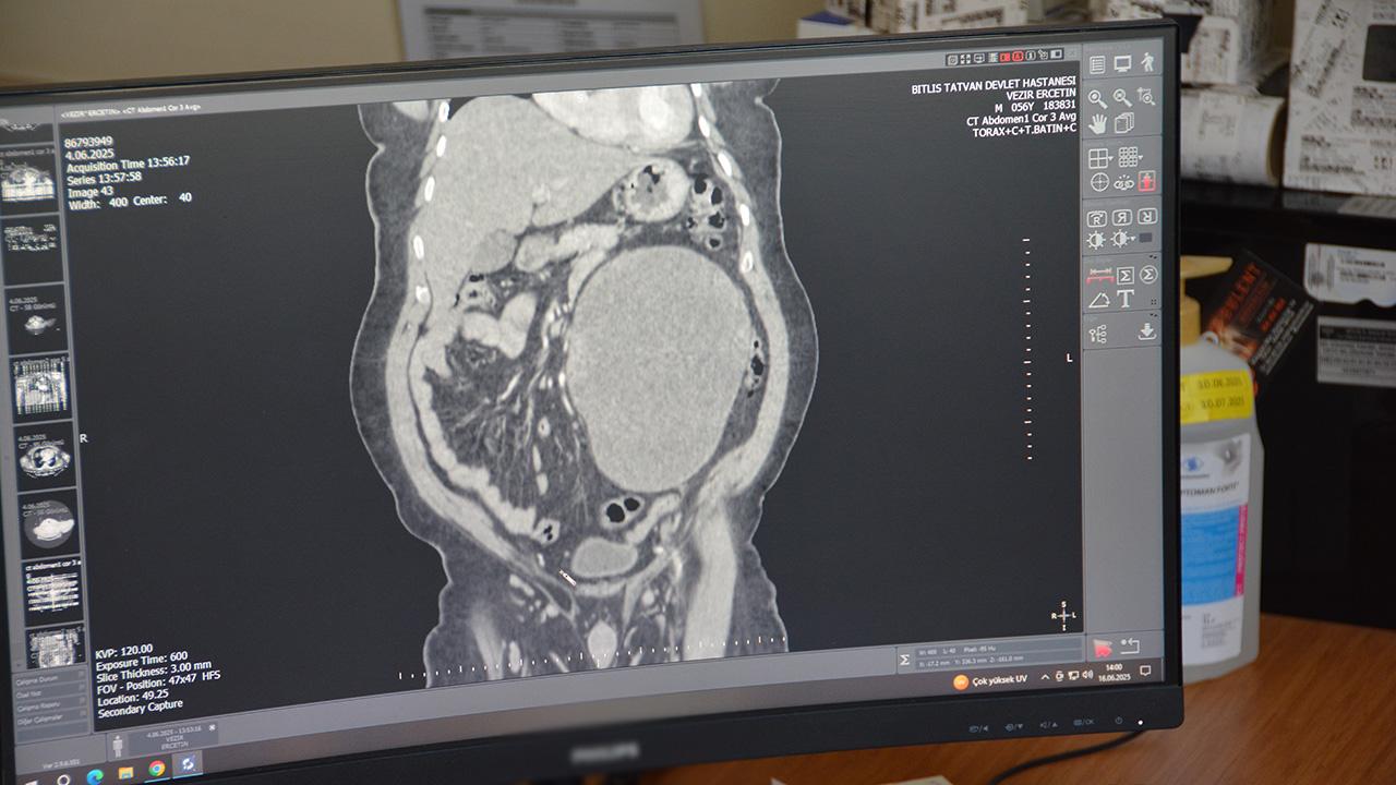 Qarın ağrısı şikayəti ilə getdi, böyrəyindən 23 santimetrlik kist çıxarıldı