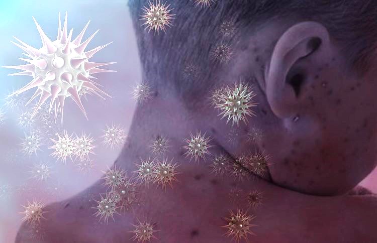 Qızılca yayılmaqdadı - Meksika və Kanadada epidemiyalar ölümlə nəticələnir