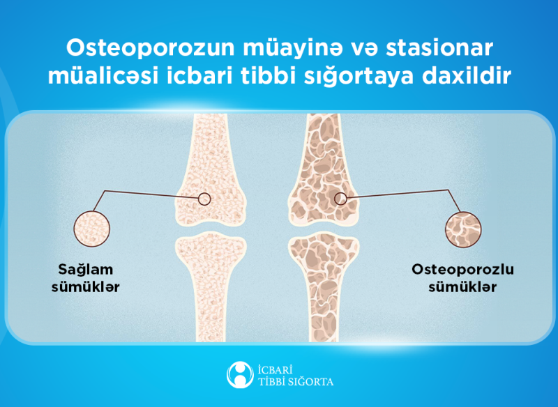Osteoporozun müayinə və stasionar müalicəsi icbari tibbi sığortaya daxildir
