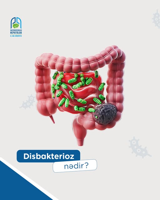 Disbakterioz nədir və sağlamlığımıza necə təsir edir? - Ekspert izahı