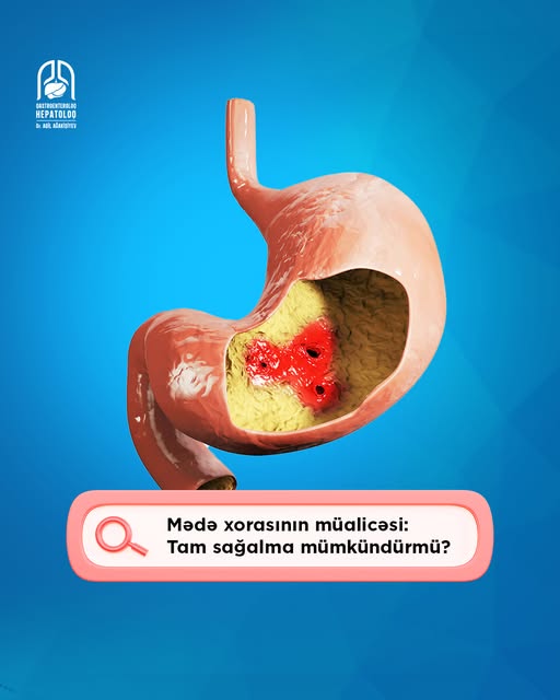 Ekspert mədə xorasının sağalmasında vacib məqamlara diqqət çəkdi