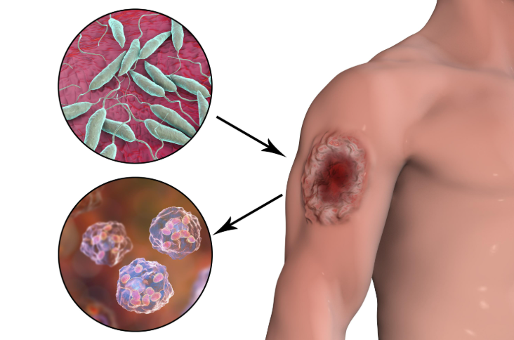 Qum milçəklərinin yaydığı leyşmanioz xəstəliyindən necə qorunmalı?