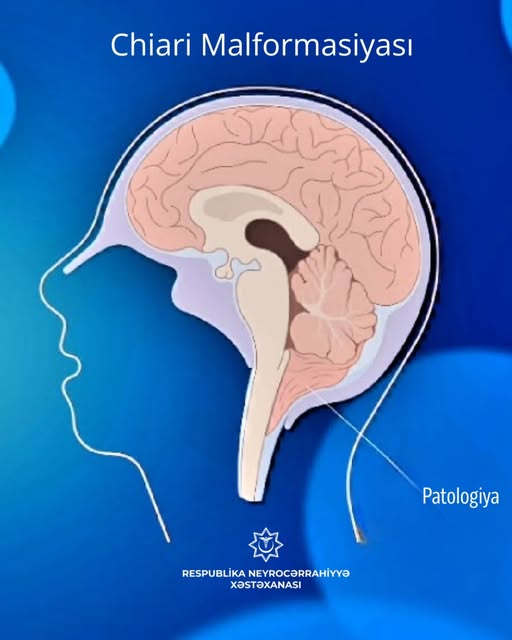 Chiari malformasiyası patologiyasının səbəbləri və müalicəsi