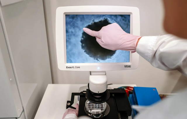 Bağırsaq xərçəngi cavanlaşır: Müayinədən keçməsi tövsiyə olunan 3 qrup insan açıqlanıb