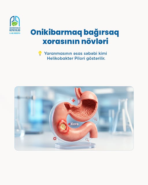 Onikibarmaq bağırsaq xorası vaxtında müdaxilə ilə nəzarət altına alınır