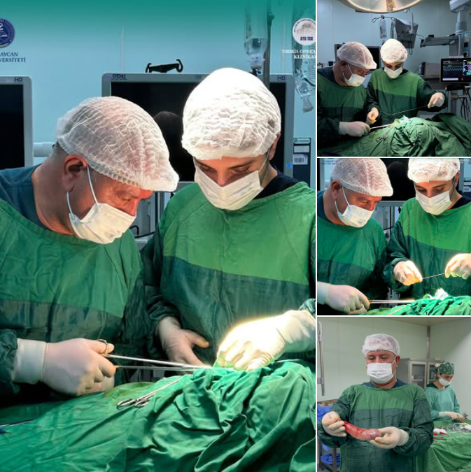 Kəskin daşlı xolesistitdən əziyyət çəkən pasiyent laparoskopik üsulla uğurlu əməliyyat keçdi