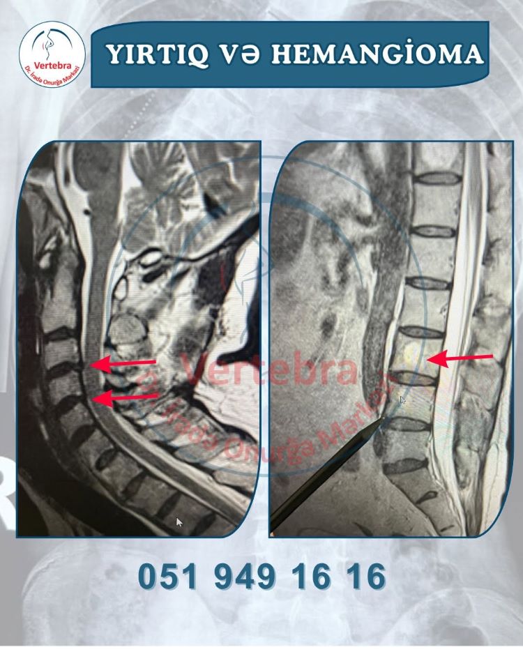 Boyun yırtığı və hemangioma eyni anda aşkarlandıqda nələrə diqqət edilməlidir?