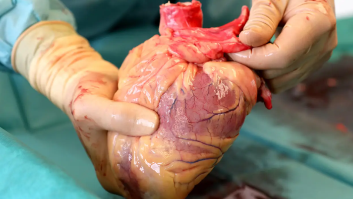 Azərbaycanda ürək transplantasiyalarının sayı 3-ə çatıb