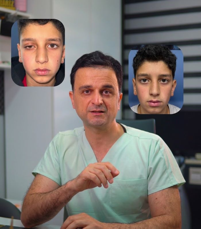 Ptoz görmə sahəsinə necə təsir edir?
